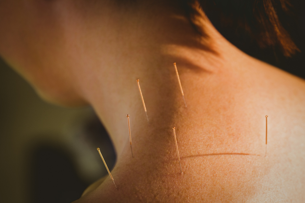 Richmond Hill acupuncture